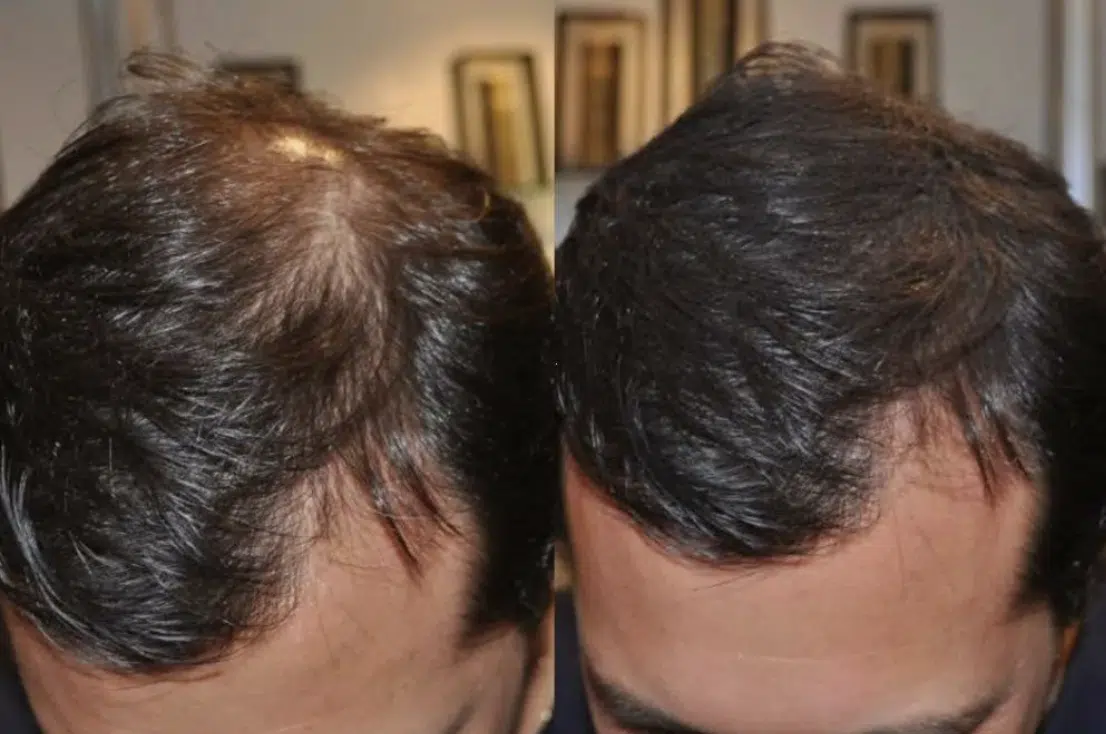 Fibre Increase Hair Growth